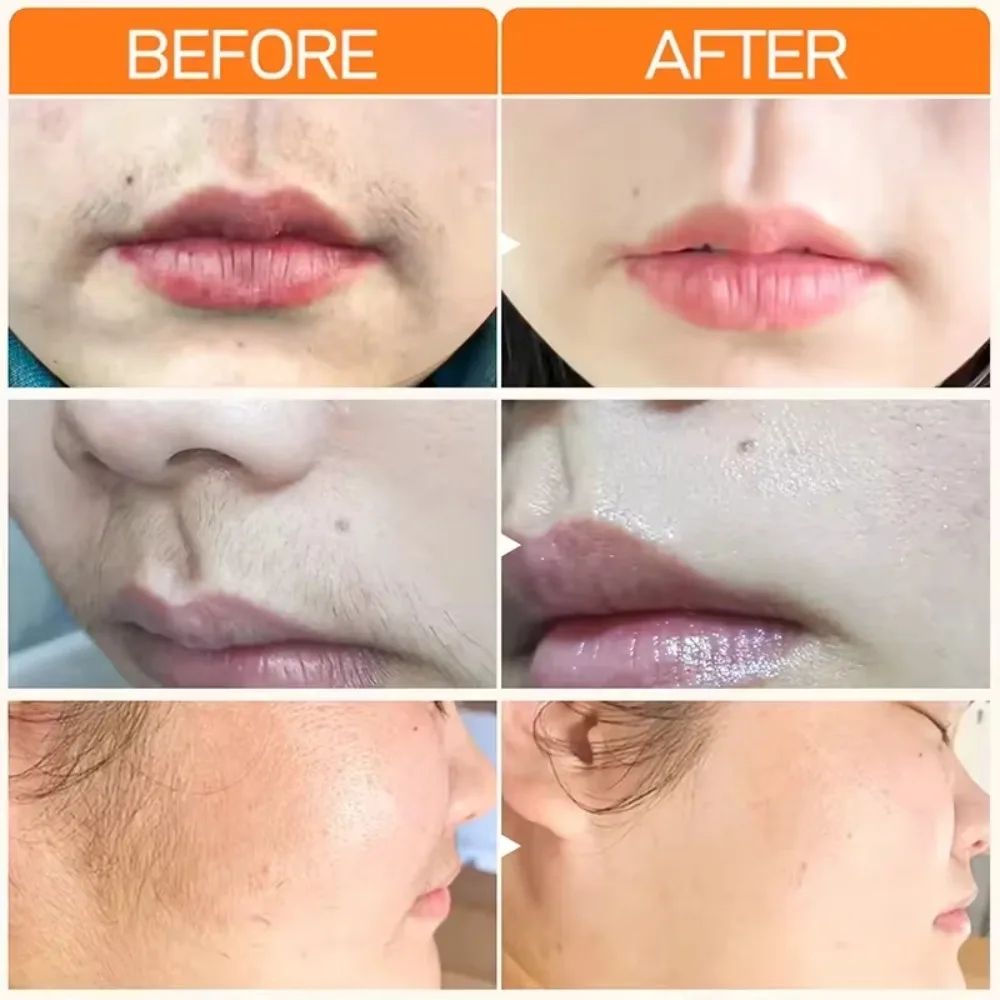 upper lip hair