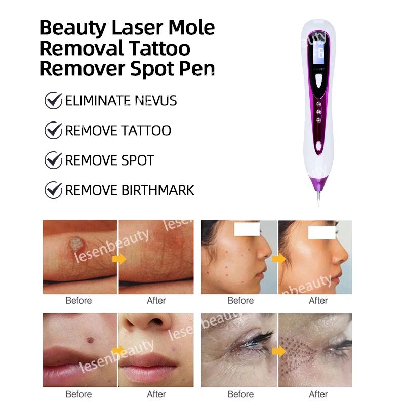 NEW Plasma Pen Mole Removal Pen Sweep